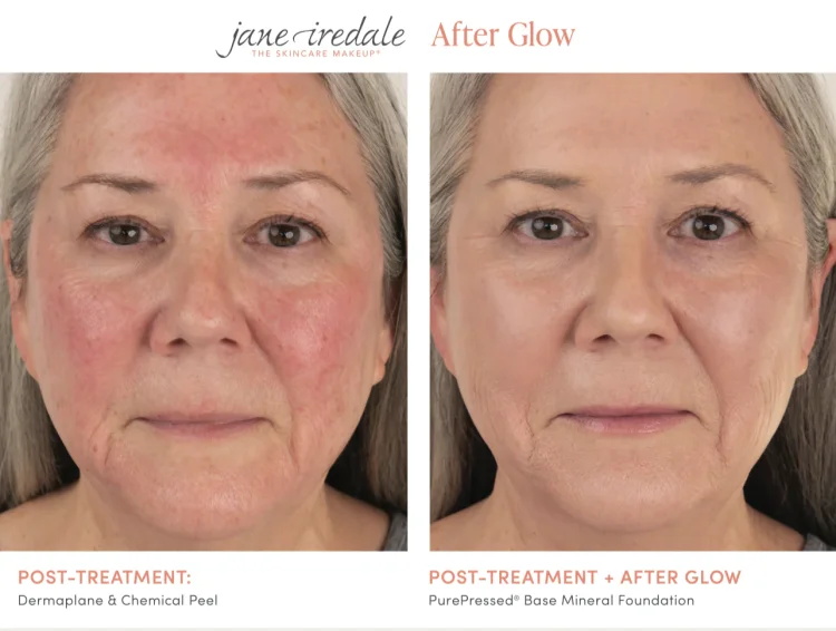 Porovnání efektu před a po použití make-upu Jane Iredale – After Glow. Vlevo pleť po ošetření se zarudnutím a podrážděním. Vpravo sjednocený tón pleti a vyhlazený finiš díky použitým produktům.